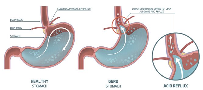 INFOGRAPHIC: What is the difference between a GERD stomach and a healthy stomach?
